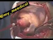 جراحی‌پیوند‌قلب💘‌‌‌‌‌‌‌‌‌‌‌‌‌‌‌‌‌‌‌‌‌‌‌‌‌‌‌