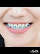 زیبایی من و رفیقم که دندونامون ارتودنسیه😁 